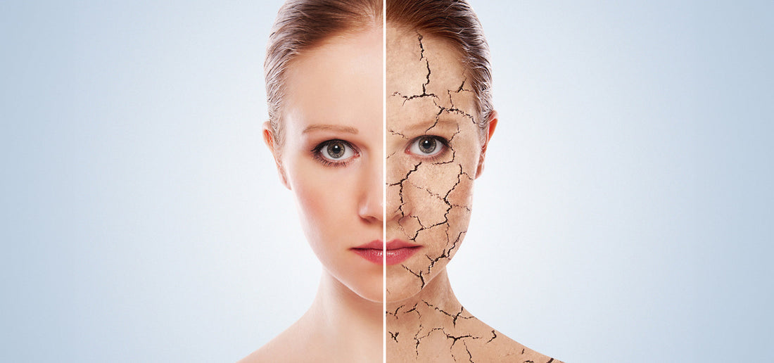 Trockene Haut im Winter