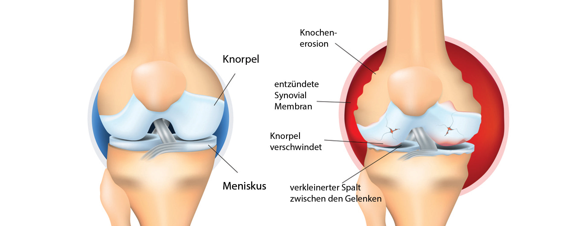 Rheuma – Überblick über Krankheitsformen
